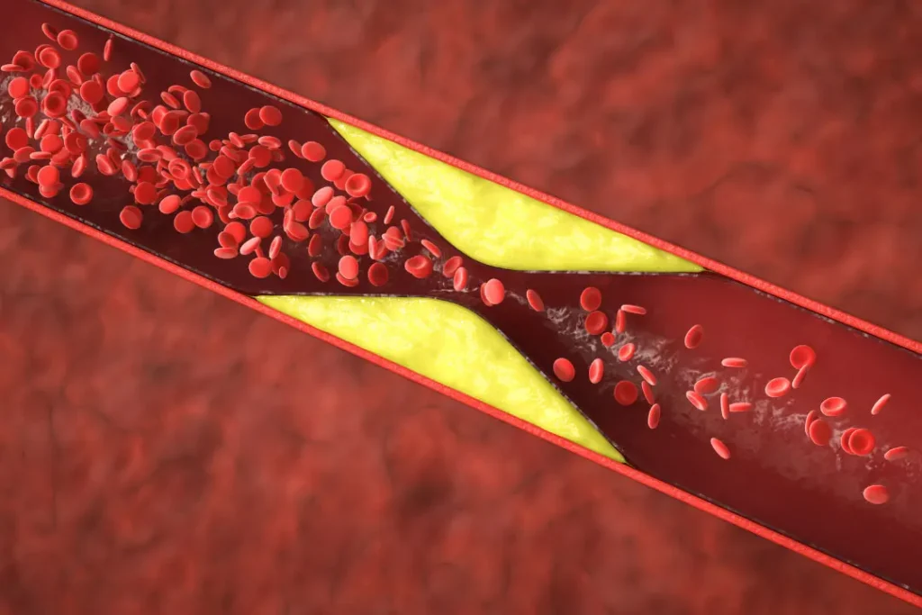 Hypercholesterolemia.