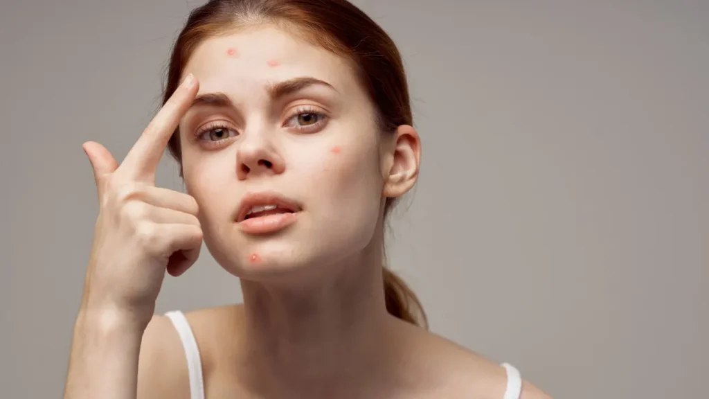 Young girl having acne on her face.